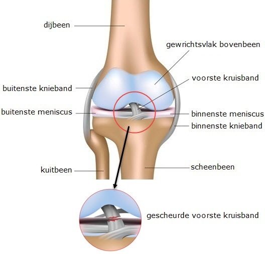 Voorste kruisband letsel