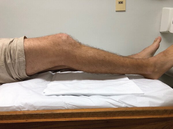 Voorste kruisband operatie knie strekking