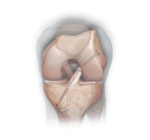 knie-VKB-reconstructie